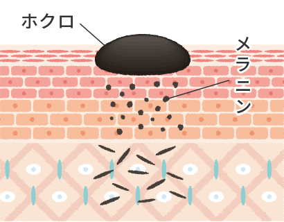 気になるほくろが数分で除去 当日治療可能！ 東京八丁堀皮膚科・形成外科